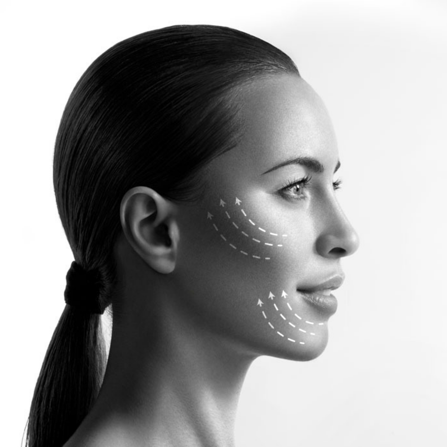Vanguard Face-Lift (Non-Invasive, HIFU)