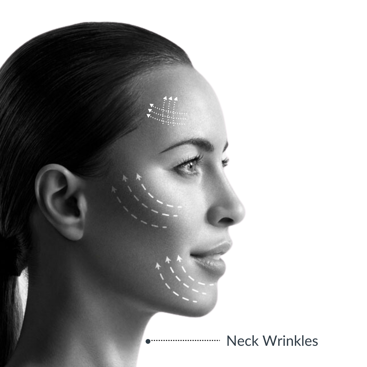 Vanguard Neck-Lift (Non-Invasive, HIFU)