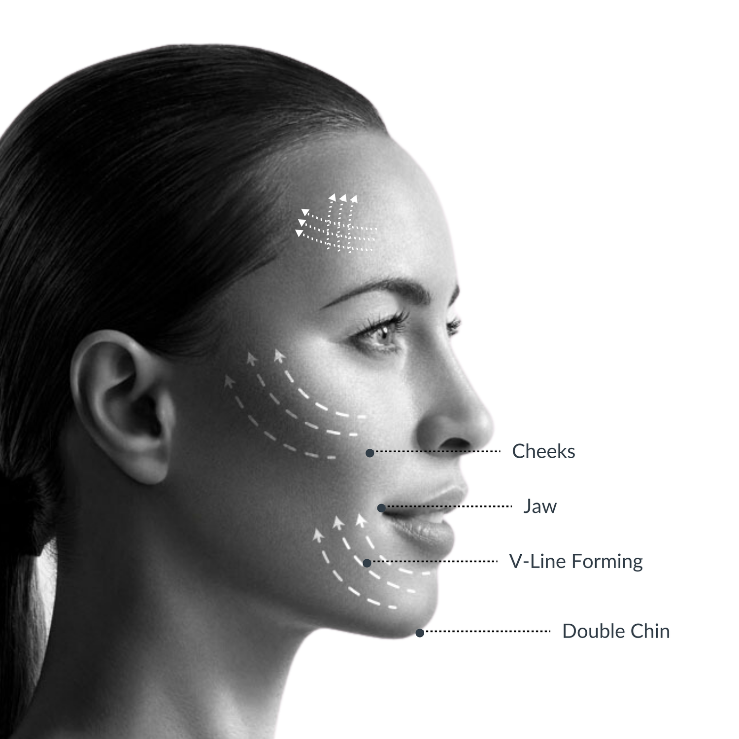 Vanguard V-Lift (Non-Invasive, HIFU)